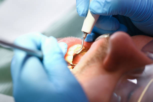 Best Emergency Tooth Extraction in Copper Canyon, TX